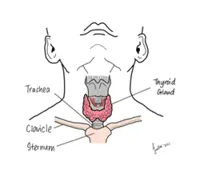 When a child's thyroid gland goes into overdrive