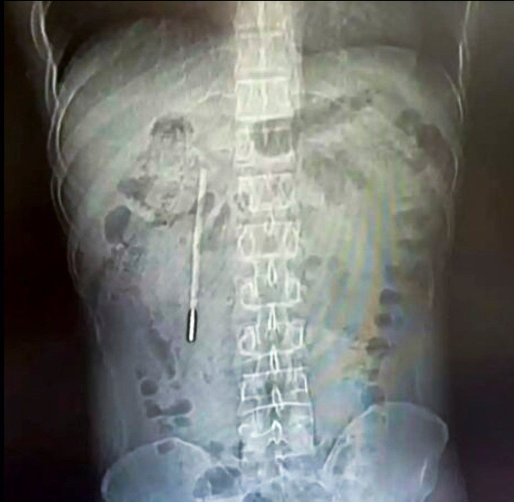 An X-ray image, above, shows the thermometer lodged inside Wang’s body. - Photo: Weibo