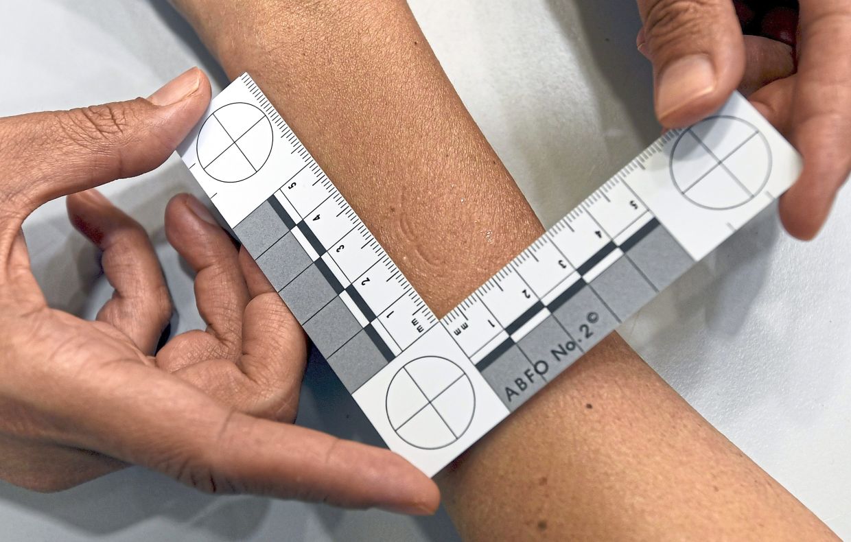 Bite mark analysis is a forensic method used to identify individuals based on the patterns left by their teeth on a victim, object or other surfaces.