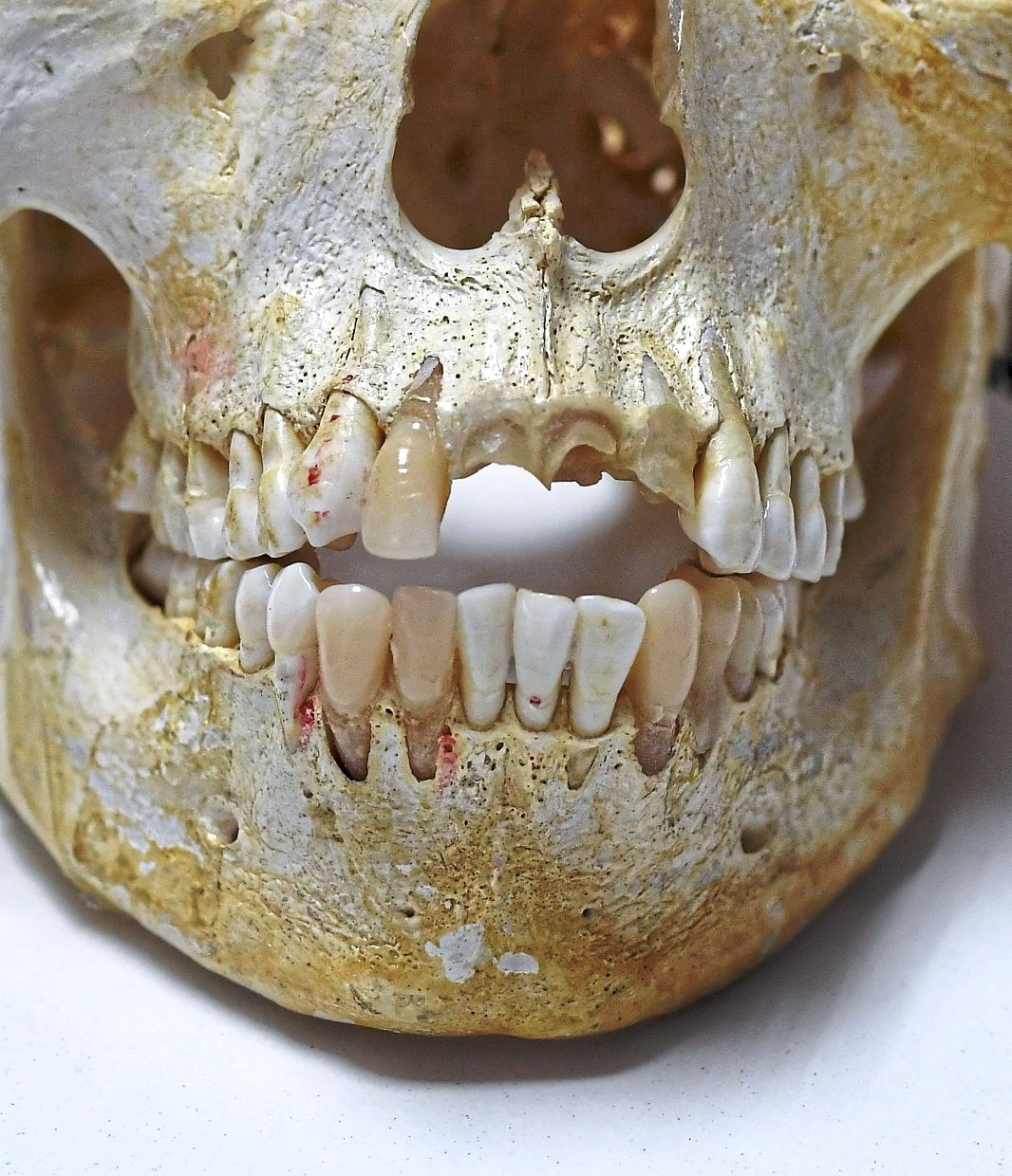 This is one of the two real human skulls used for educational purposes at UM’s dental faculty. The rest are replicas.