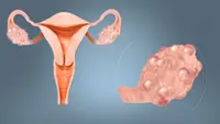 A name change for PCOS
