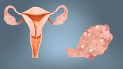 A name change for PCOS