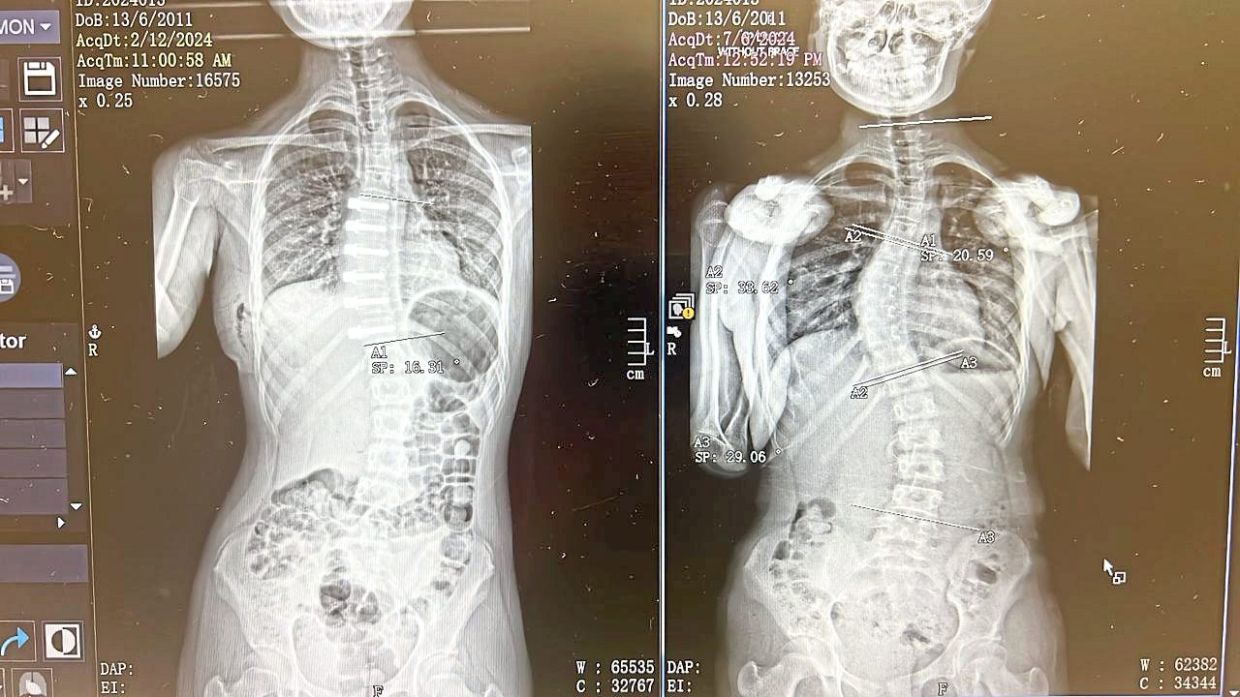 These X-rays show the correction of a scoliosis patient’s spine from before (right) to six months after a thoracic VBT surgery. — Dr WONG CHUNG CHEK