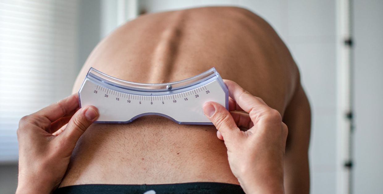 Scoliosis is defined as a lateral curvature of the spine of 10“ or more, but doctors only consider surgery when the angle reaches 40“. — Handout