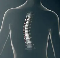 Scoliosis: Treating with tension, instead of fusion