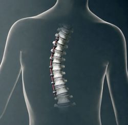 Scoliosis: Treating with tension, instead of fusion
