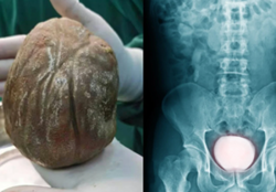 Man in China who suffered painful urination for three years discovers 1.3kg stone in bladder