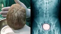 Chinese man who suffered painful urination for three years discovers 1.3kg stone in bladder