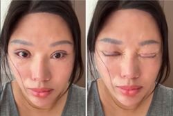 ‘Sleeping with my eyes open’: China woman’s bungled double eyelid surgery causes complications