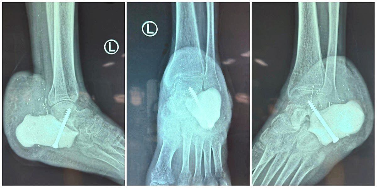 This post-surgery X-ray shows the 3D-printed part that has effectively replaced the patient’s original calcaneum (heel bone).