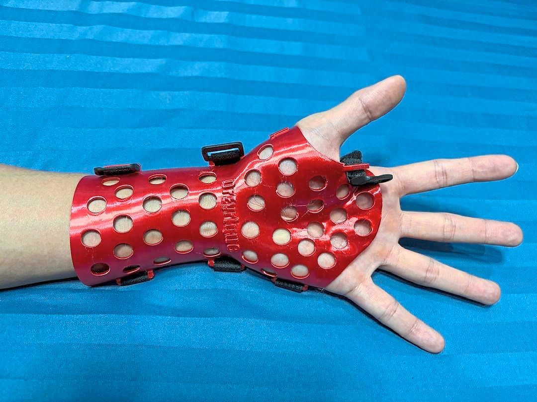 Dr Goh is also experimenting with creating 3D-printed mesh casts to replace the typical plaster of Paris used to hold wrist fractures in place for it to heal.