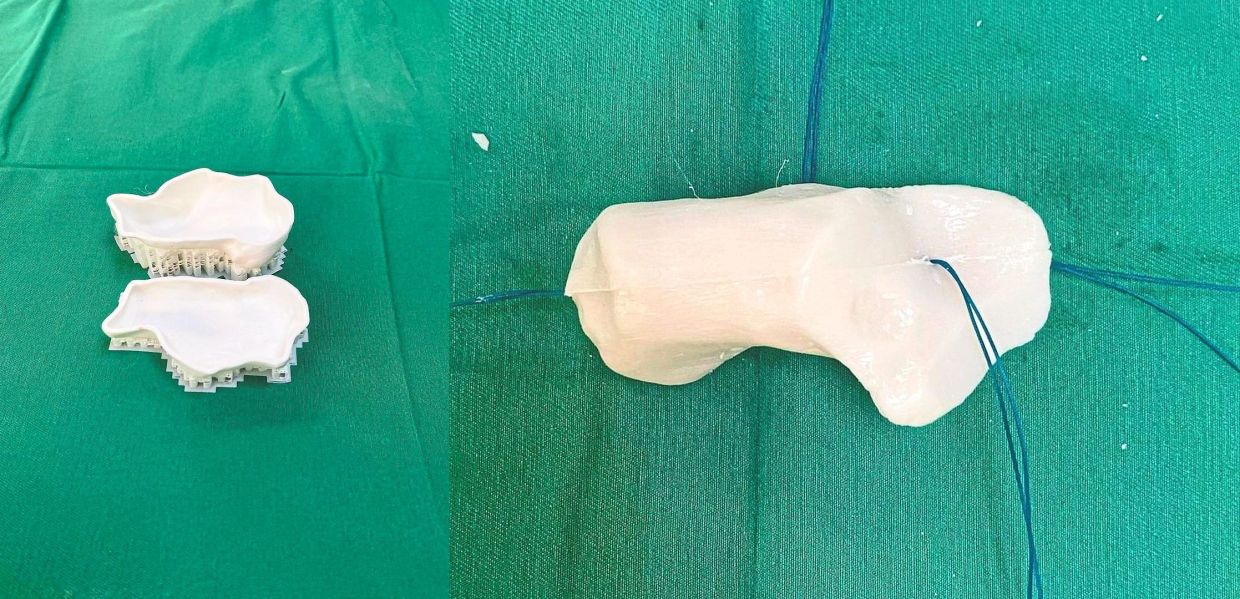 On the left is a 3D-printed mould of a patient's calcaneum (heel bone), which Dr Goh created at home. Just before the surgery, antibiotic bone cement is poured into this mould, which is then clasped together to allow the cement to harden into the replacement calcaneum (right). The mould will then be peeled off and the bone replacement implanted in the patient immediately.