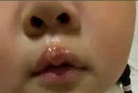 China teacher under probe after using glue gun to scald little girl, resulting in blisters