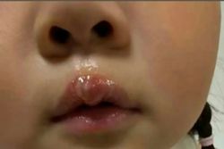 China teacher under probe after using glue gun to scald little girl, resulting in blisters