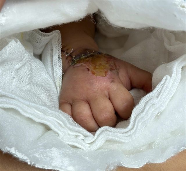 The patient's hand is pink and recovering well after surgery. - Photo: benhvienvietduc.org