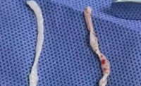 Chinese doctors remove pair of 10cm live worms from woman’s arm after year-long pain