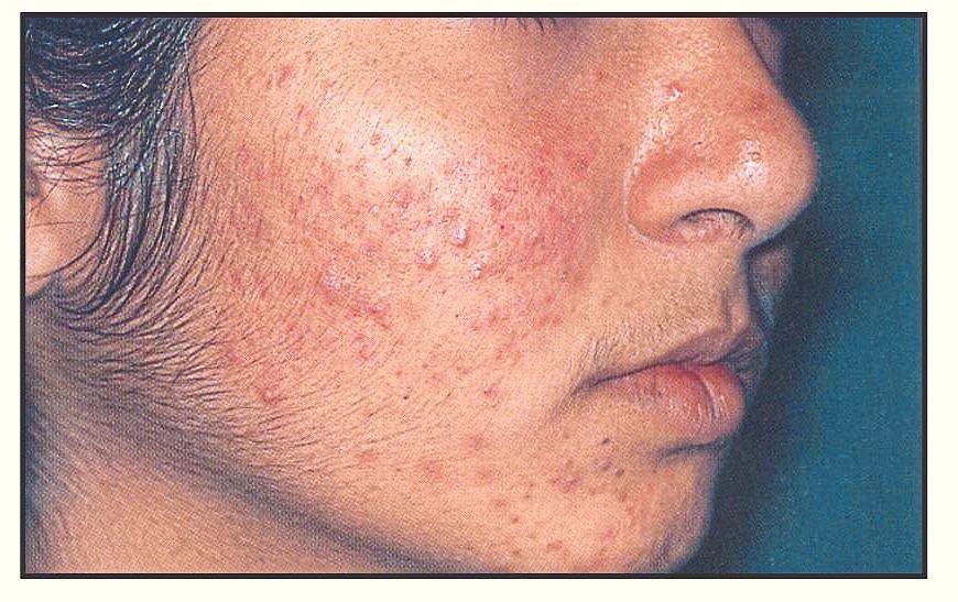 Acne in women with PMOS is primarily driven by hyperandrogenism (excess androgens like testosterone) and insulin resistance. It frequently presents as stubborn, moderate-to-severe hormonal acne localised along the jawline, chin and neck. — Wikimedia Commons