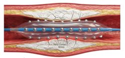 Cracking those hardened plaques in your heart arteries