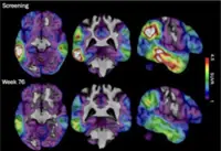 Blood test may predict cognitive decline in cognitively unimpaired older adults: study