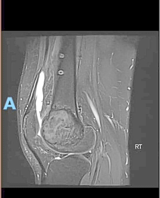 Tham’s first MRI clearly reveals the giant cell tumour growing inside his distal femur bone. — THAM MOH GEE