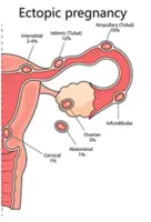 Ectopic pregnancies are a top killer of mothers