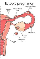 Ectopic pregnancies are a top killer of mothers