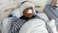‘True everyday hero’: Chinese man has nose bitten off saving woman from attacker