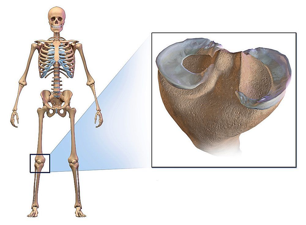 The meniscus is a tough, C-shaped piece of cartilage that acts as a shock absorber between your thighbone (femur) and shinbone (tibia). — Wikimedia Commons