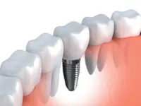 Avoiding that dental implant infection