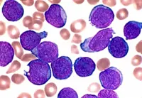 Leukaemia is not just one disease