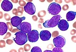 Leukaemia is not just one disease