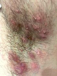 When you get recurring boils and abscesses