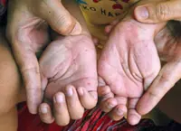 ‘Vax for HFMD being assessed’