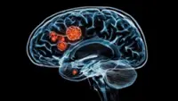 Researchers in Australia develop new approach to deliver cancer drugs into brain