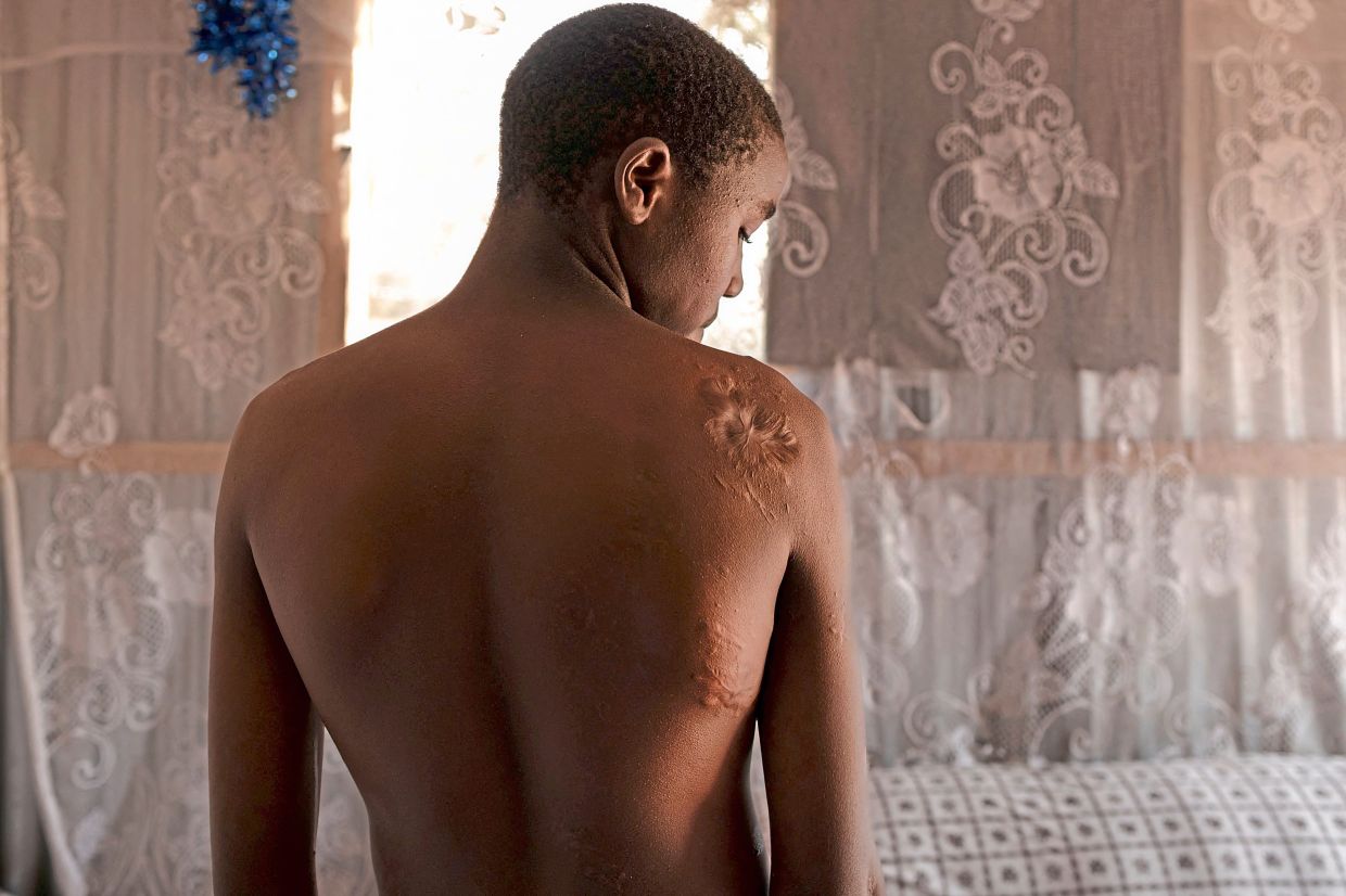 A teenage boy shows scars on his body from a crocodile attack on Lake Bogoria, a decade after he lost his father to another attack by a hippopotamus in the wake of increased proximity of wildlife to human settlements.