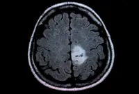 AI could help spare brain tumour patients MRI dye injections
