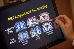 We can all lower our risk of developing dementia