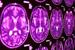 What is a brain aneurysm?