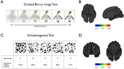 Australian researchers develop eye tests to detect early signs of dementia