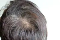 QuickCheck: Does plucking out a white hair cause more to grow in its place?